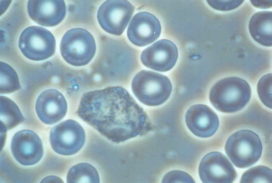 Healthy blood: erythrocytes, acanthocytes