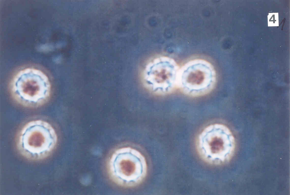 Leukemia - 40x Phase contrast